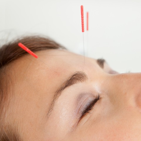 Lifting par acupuncture & méthodes naturelles